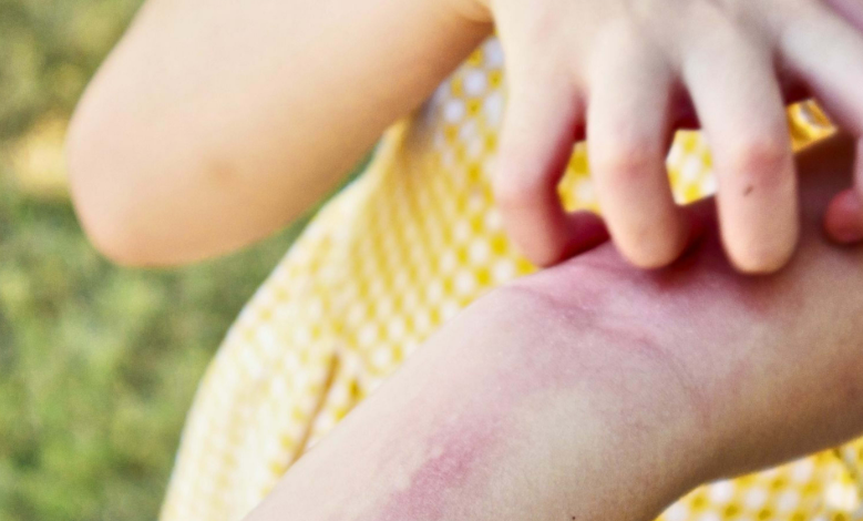 Bed Bug Bites on Babies: Signs and Safe Treatments